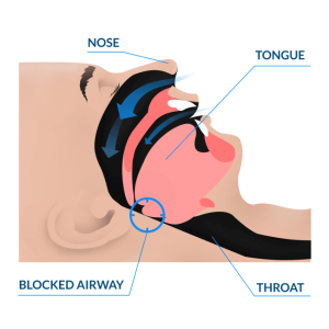 snoring is causded by a blocked airway